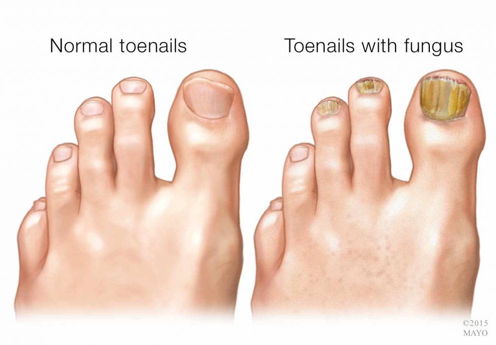 bacterial nail infection